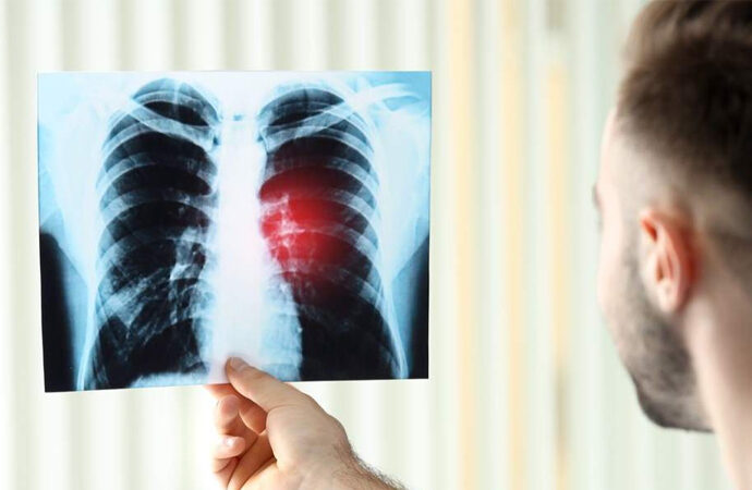 Un progetto “Topp” per i pazienti con tumore polmonare