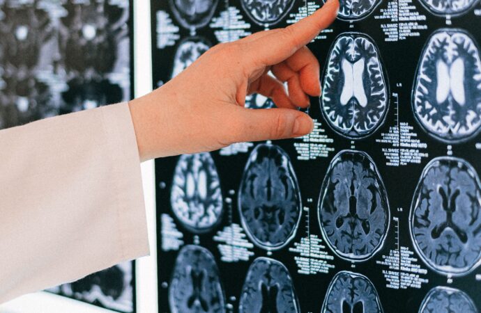 Emicrania, all’Aou di Sassari tutte le principali terapie specialistiche disponibili